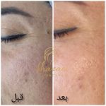 فیشال و پاکسازی پوست درنواب