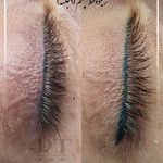 مرکز میکروبلیدینگ، شیدینگ، اسکالپ، ریموو
