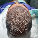 کاشت مو و ابرو (مرجان عاشوری)