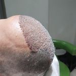 کاشت مو و ابرو (مرجان عاشوری)