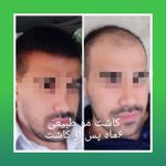 کلینیک کاشت مو و ابرو آذرنوش