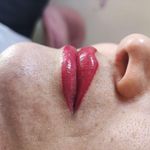 میکروبلیدینگ راحیل