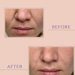 کلینیک لیزر هایفو اندولیفت لکسیر