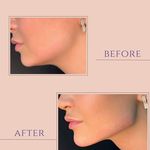 کلینیک لیزر هایفو اندولیفت لکسیر