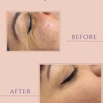 کلینیک لیزر هایفو اندولیفت لکسیر