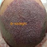 کلینیک کاشت مو و ابرو بابل تزریق چربی