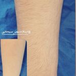 اپیلاسیون سبحانی