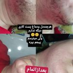 متخصص الکترولیزورفع دائمی صورت بانوان