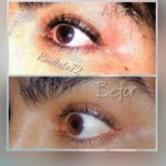 فیبروز میکروبلیدینگ و خدمات تاتو ابرا