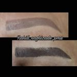 میکروبلیدینگ راحیل