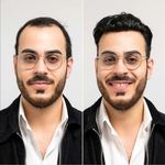 پروتز موی تیامسیس