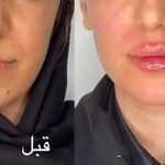 تزریق فیلر و بوتاکس لیزرموهای زائد