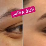 تزریق فیلر و بوتاکس لیزرموهای زائد