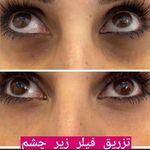 تزریق فیلر و بوتاکس لیزرموهای زائد