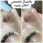 پاکسازی و فشیال تخصصی پوست فاطمه توکلی