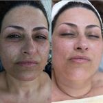 فشیال و پاکسازی پوست