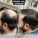 مرکز تخصصی کاشت مو محمدی