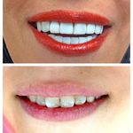 دندانپزشکی تاج دنتال