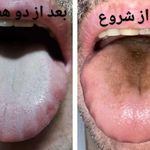 مشاوره رایگان تشخیص بیماریها از روی زبان