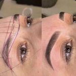 میکروبلیدینگ و فیبروز ابرو