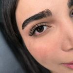 کاشت مژه مونلَش (Moonlash)