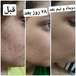 خدمات پاکسازی فیشال پوست