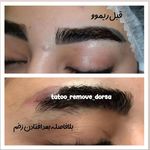 تتو و ریموو تتو درسا