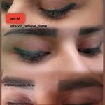 تتو و ریموو تتو درسا