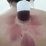 طب سنتی عامری (حجامت و بادکش)