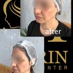 کلینیک زیبایی شارین _بوتاکس ،لیزر،بلفارو