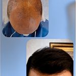 کلینیک کاشت مو منا تصوری