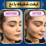 کلینیک تخصصی لیزر و لیفت نخ لولیتا