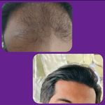 کلینیک کاشت مو منا تصوری