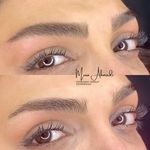 میکروبلیدینگ فیبروز مینا احمدی