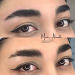 میکروبلیدینگ فیبروز مینا احمدی