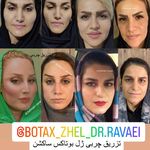 لیزر co2ترکیبی ضدلک وجوانساز کلینیک رایدو