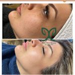 پاکسازی پوست  فیشال