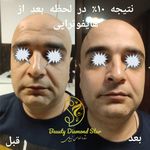 هایفوتراپی ستاره الماس زیبایی