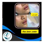 مرکزکلینیک لیزر زیبایی پوست و مو آسا