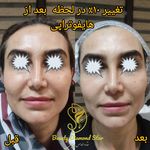 هایفوتراپی ستاره الماس زیبایی