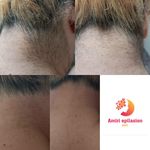 اپیلاسیون تخصصی بدن بانوان در ساری