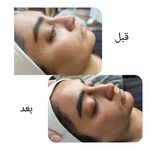 جوانسازی صورت و گردن