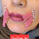 مطب پوست و زیبایی و لیزر بنفشه