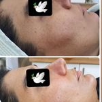 فشیال و پاکسازی پوست طهماسبی