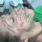 طب سوزنی زیبایی