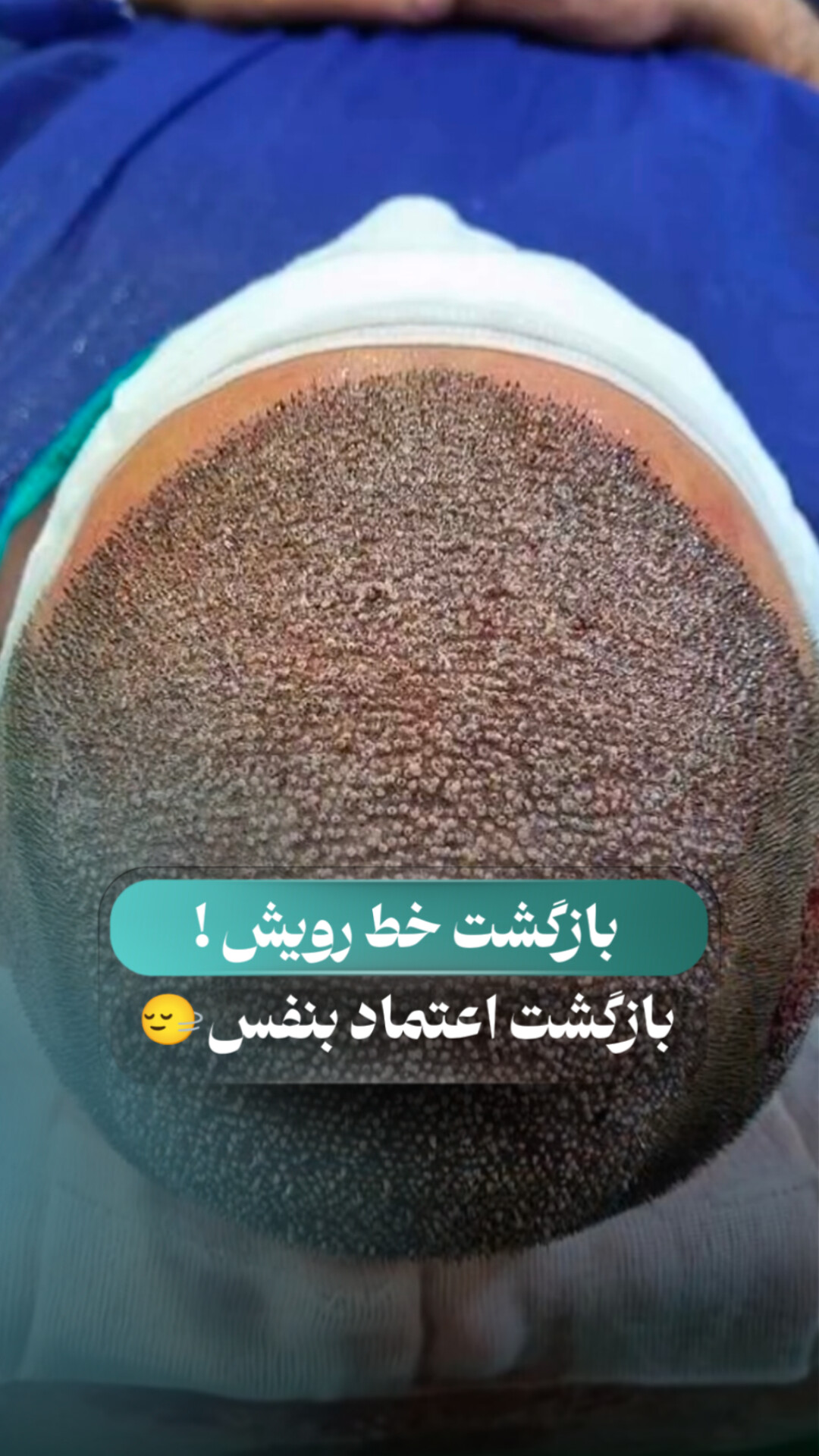 کاشت مو ابان