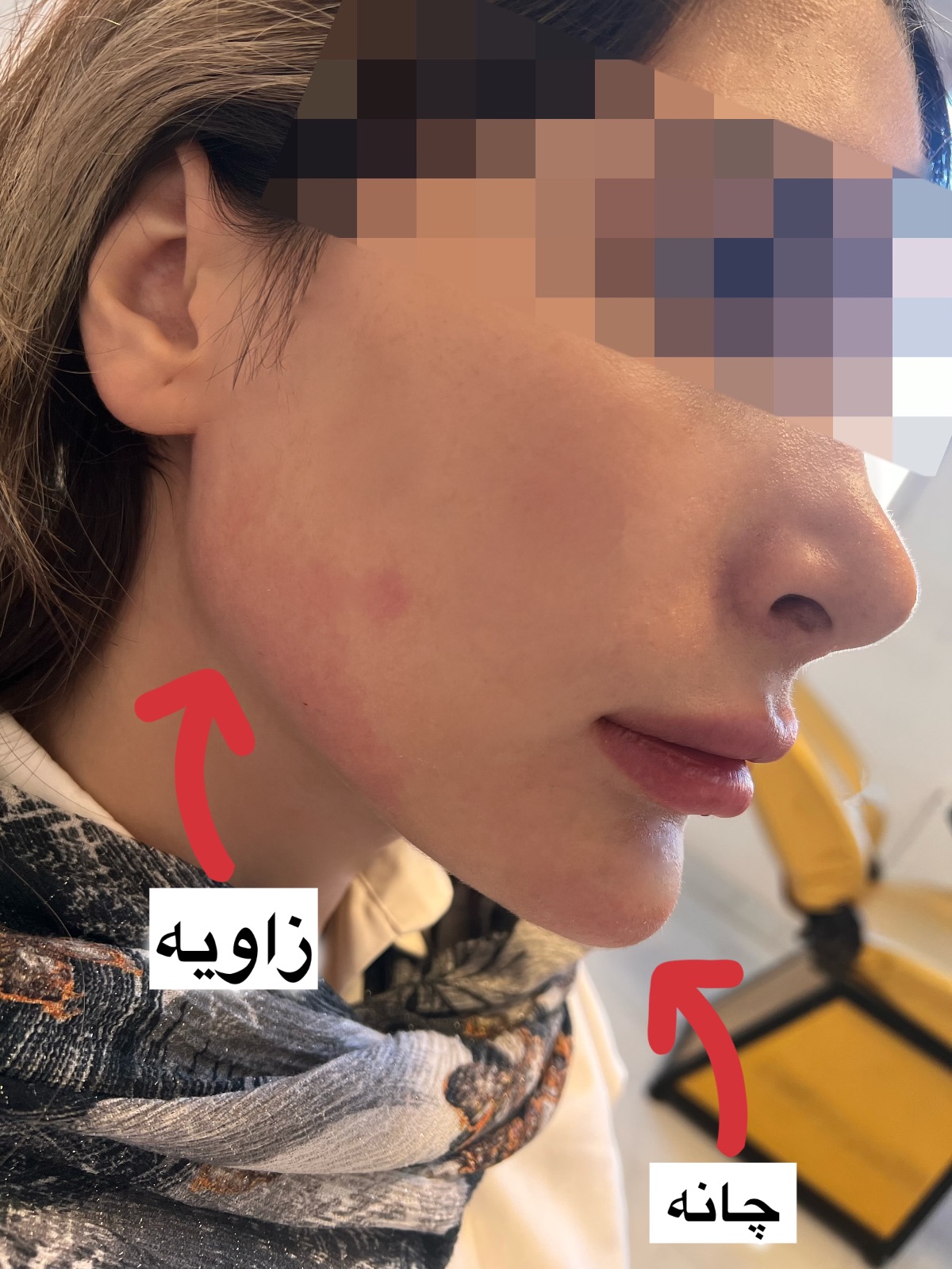 آفر ۹۰ درصدی ژل و بوتاکس و پی آر پی‌ و نخ