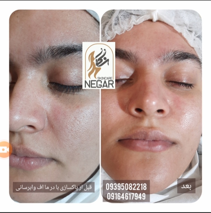 فیشیال و پاکسازی نگار
