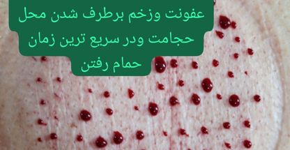 حجامت تخصصی کل بدن اکبرکریمی(سیار)