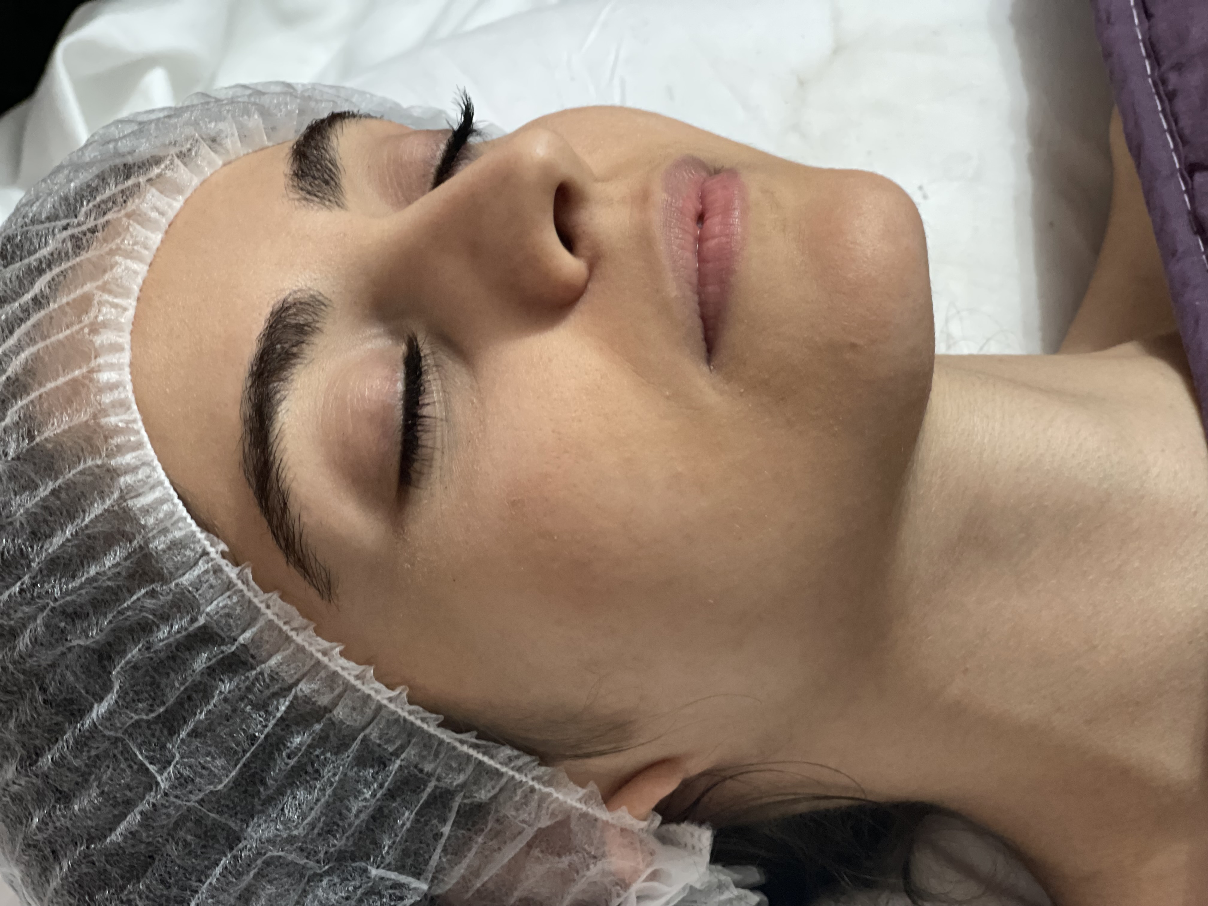 فیشال و پاکسازی صورت لوئیز